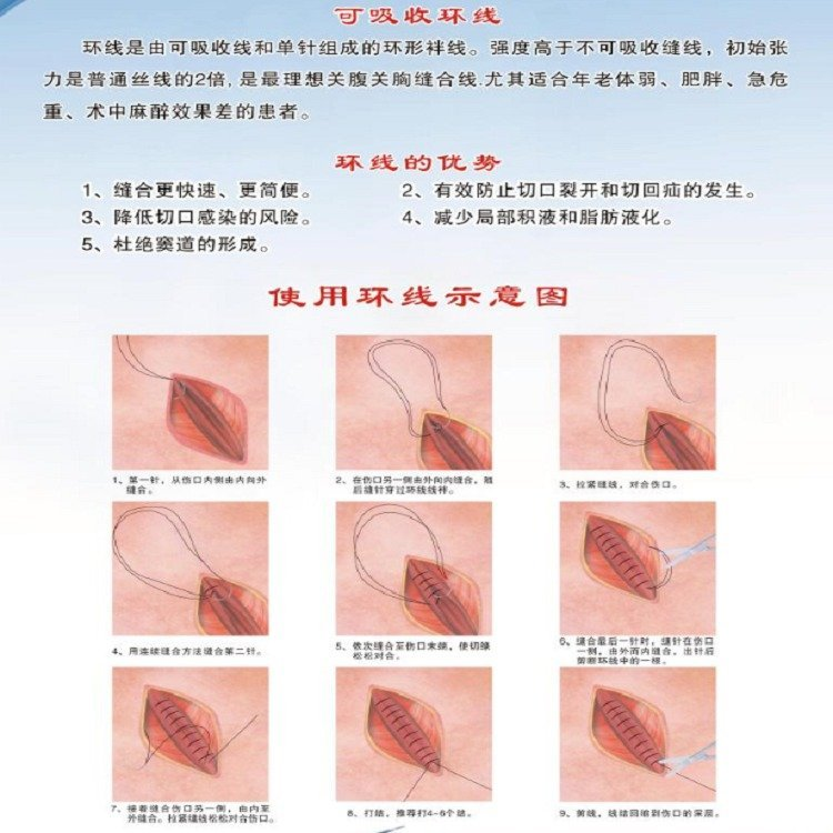 八针八线 段装埋线可吸收性外科缝线